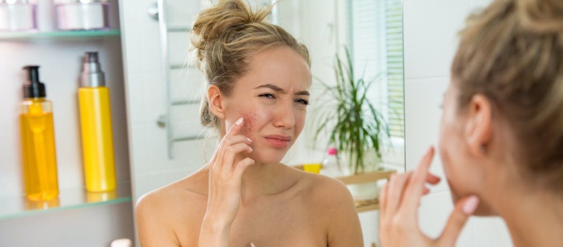 Comment soigner l’acné chez l’adolescent ?