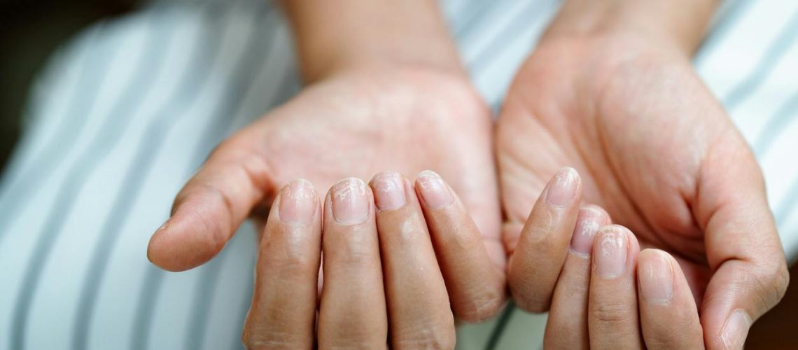 Comment traiter un psoriasis de l’ongle ou psoriasis unguéal ?