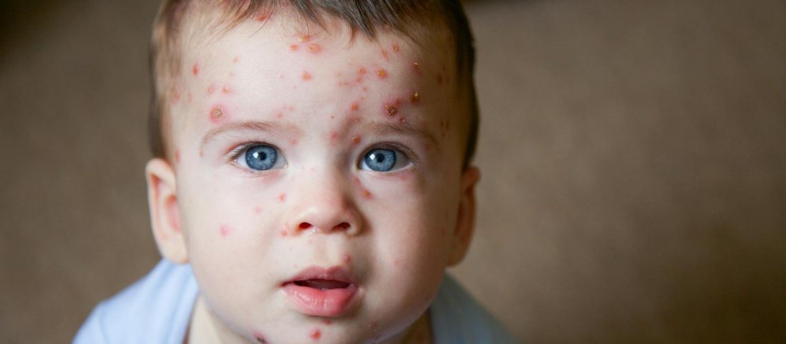 Qu'est-ce qu'un exanthème ?